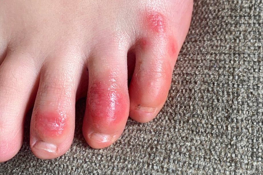 covid-toes-other-rashes-latest-possible-rare-virus-signs-positive