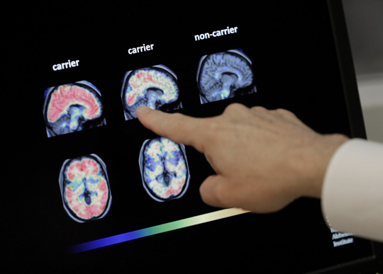 PET brain scan